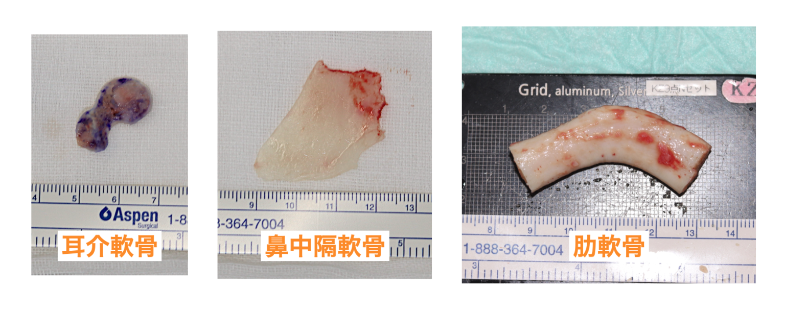 肋軟骨炎の原因は何ですか?